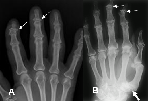 Image result for artropatia