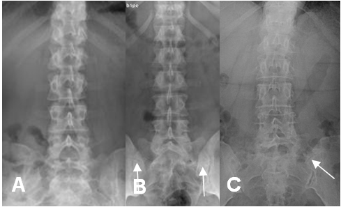 Radiografía de la columna lumbar, perfil