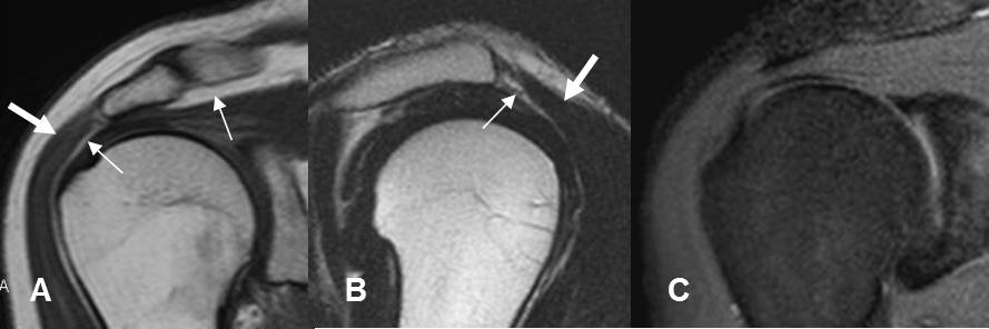 Resonancia magnética de la rodilla derecha. A y B) Secuencias sagital y